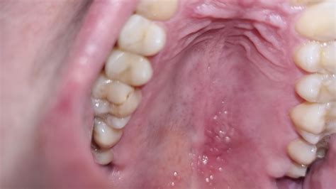 Concerned re. Lesions on hard palate : r/askdentists