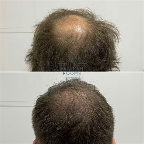 Balding Crown & Crown Hair Transplant | Treatment Rooms London