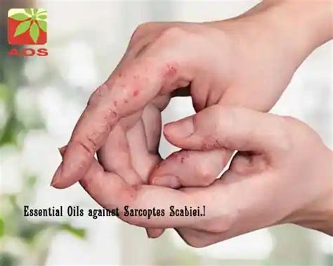 Essential Oils for Scabies Itching: Learn More | AOS Blog