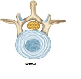 CLASSIFICATION OF HERNIATED DISC