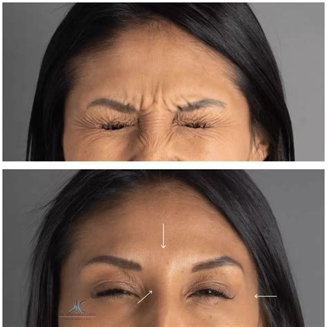Botox Before And After Results | Dr. Abraham Cazares
