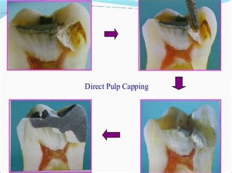 Image result for Direct Pulp Capping Vs RCT
