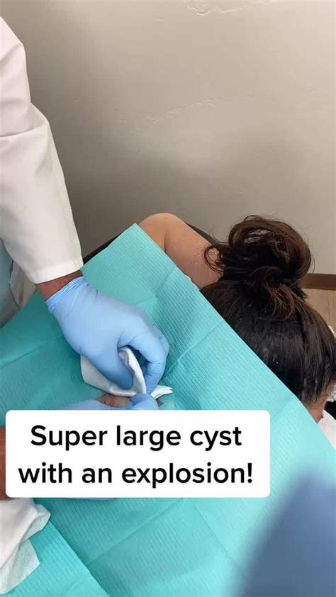 Largest Exploding Cyst 的图像结果