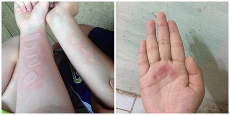 Ice And Salt Challenge Burns