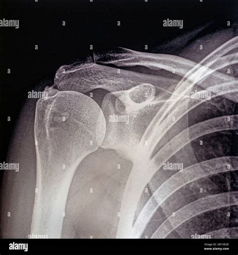 Internal Rotation Shoulder Xray