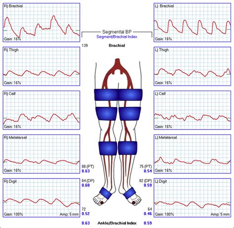 Pulse Volume Recording