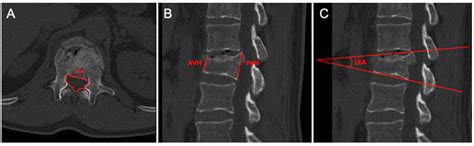 Percutaneous Treatment of Traumatic A3 Burst Fractures of the ...