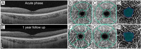 The Comparison of Retinal Microvascular Findings in Acute COVID-19 and ...