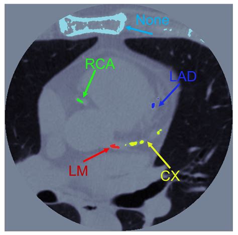 Development of a Web Application for the Detection of Coronary Artery ...