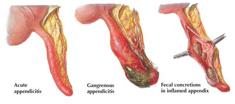 Image result for Perforated Appendix