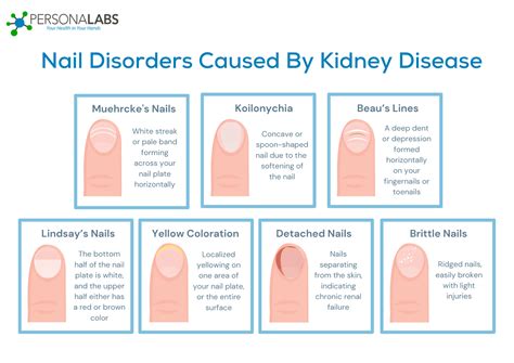 What Do Your Nails Look Like With Kidney Disease? | Personalabs