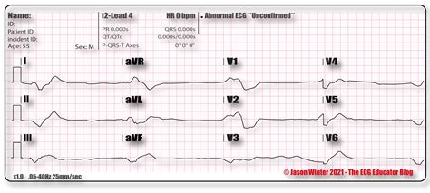 ECG Educator Blog : Agonal Rhythm