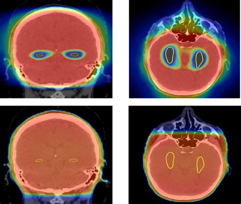 Understanding The After Effects Of Full Brain Radiation