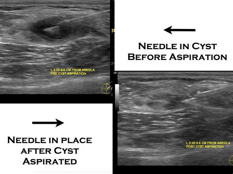 Ultrasound Guided Biopsy Rigler's sign - Radiology at St. Vincent's ...