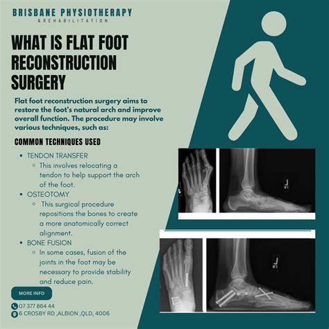 Flat Foot Reconstruction Surgery: What to Expect and the Role of Physiotherapy in Recovery ...