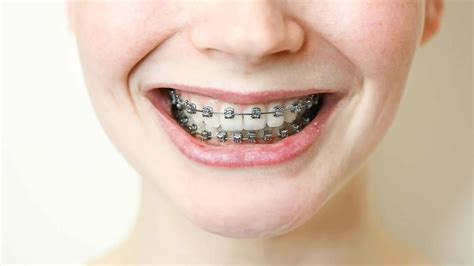Can braces fix teeth damaged by thumb sucking? - Dental Health Clinic