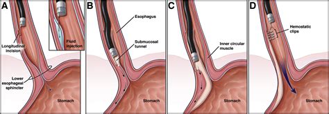 Peroral Endoscopic Myotomy