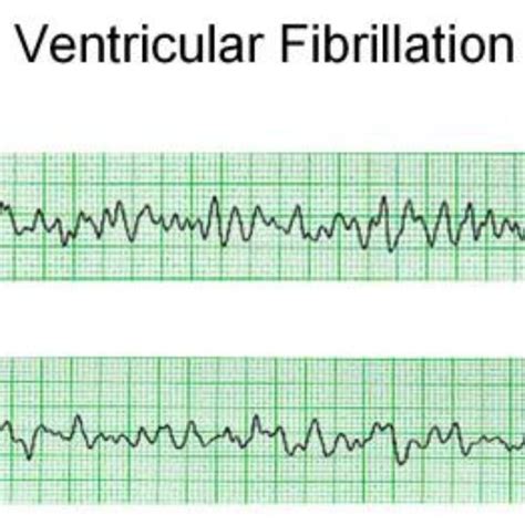 Importance of Early Defibrillation for Ventricular Fibrillation