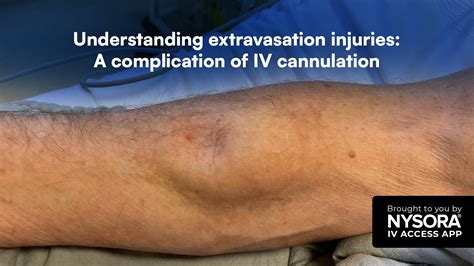 Finding the perfect vein: Tips for selecting the ideal site for IV cannulation - NYSORA
