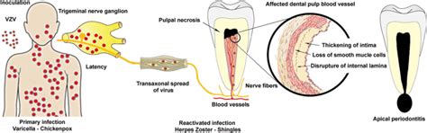 Pathology Of Varicella-Zoster Virus (VZV) Infection AMI, 41% OFF