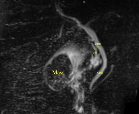 Image result for MRCP Biliary Tree