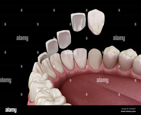 Maxillary Lateral Incisor