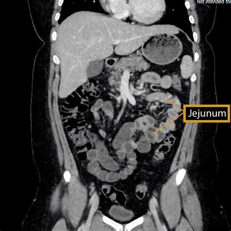 Image result for Small Intestine Jejunum