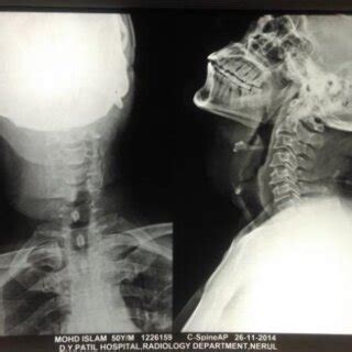 Image result for Neck X-Ray