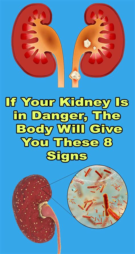 What Are The Warning Signs Of Kidney Infection at Robert Gump blog