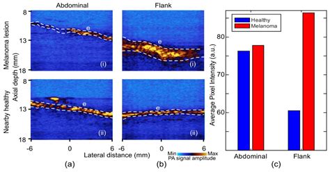 Photoacoustic/Ultrasound/Optical Coherence Tomography Evaluation of ...