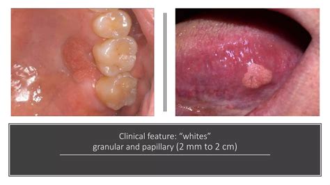 Squamous Papilloma and Verruciform Xanthoma (Doctor Faris Alabeedi MSc, MMedSc, PgDip, BDS.) | PPTX