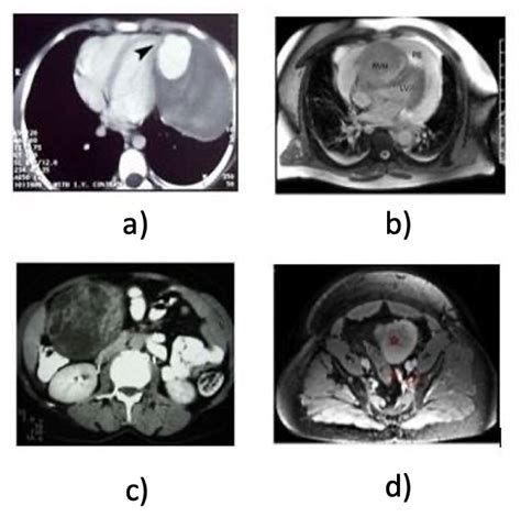 A Modified HSIFT Descriptor for Medical Image Classification of Anatomy ...