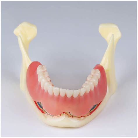 Buy Teeth Teaching Model - Denture Im And Restoration Anatomical Jaw ...