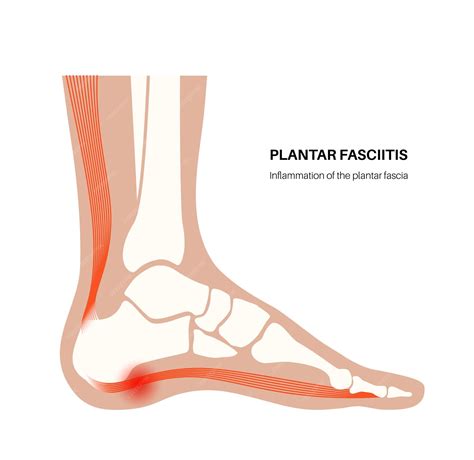 Plantar Fasciitis 的图像结果