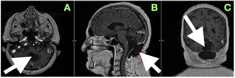 Fourth Ventricle Epidermoid Cyst: Case Report of Precision Telovelar ...