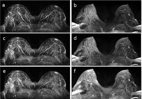 Image result for Maximum Intensity Projection Python