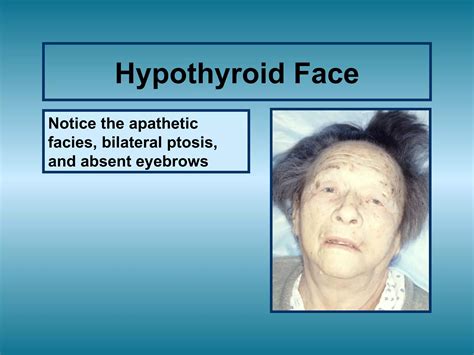 Hypothyroidism Signs and Symptoms Hypothyroidism Signs and Symptoms | PPT