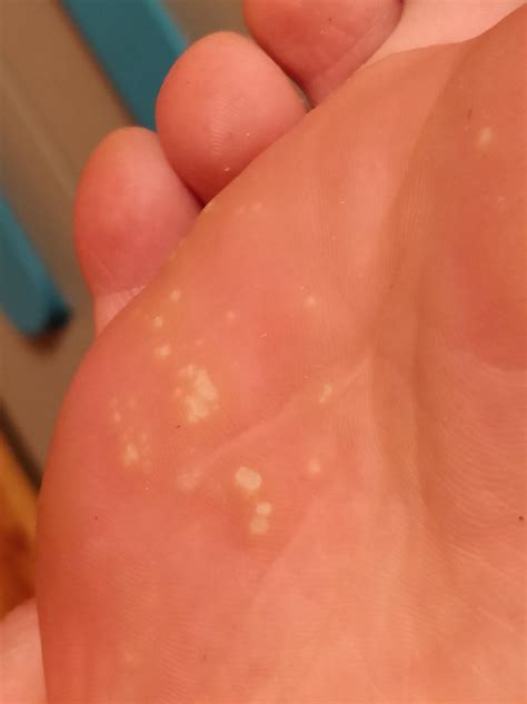 white bumps on foot. : r/Dermatology