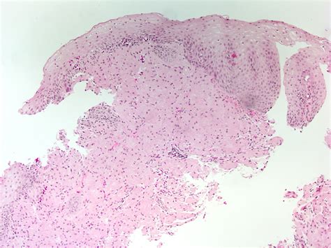 Pathology Outlines - Granular cell tumor