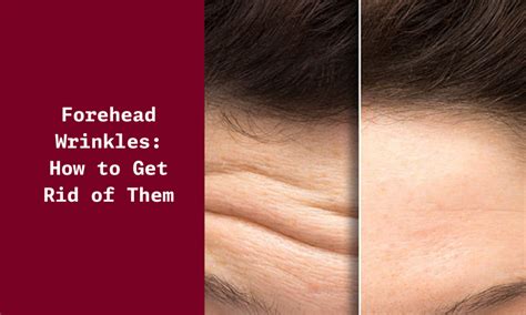How to Get Rid of Forehead Wrinkles - Causes & Types of Forehead ...