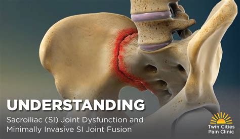 Understanding SI Joint Dysfunction & Minimally Invasive Fusion