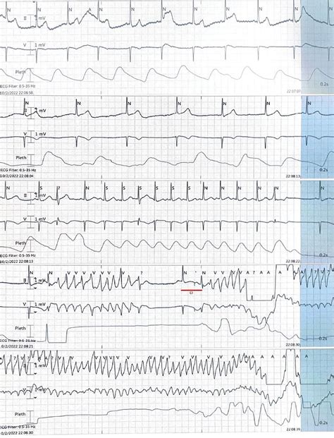 Micturition Syncope…Not Always Benign | Circulation