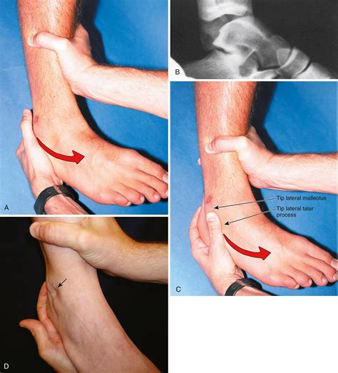 Sports Injuries of the Ankle - Clinical Tree