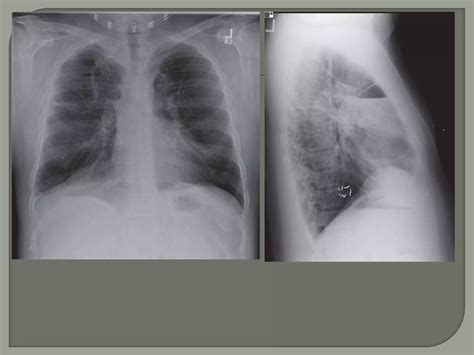 Bullous disease of lung.pptx