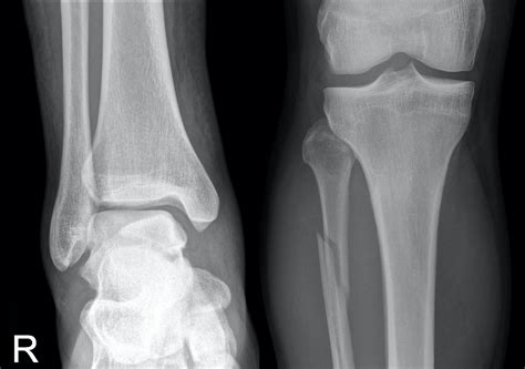 Maisonneuve Fracture • LITFL • Medical Eponym Library