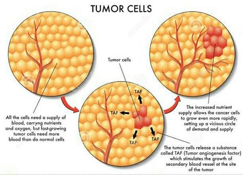 cara mengobati tumor ginjal