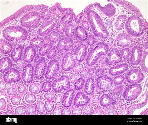 Polyps In Colon Tubular Adenoma at Daniel Isaac blog