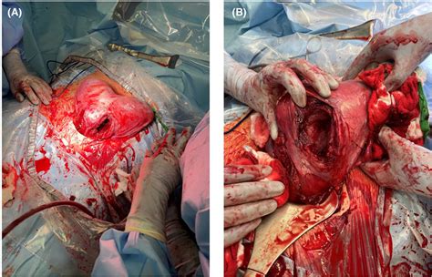 Dicavitary twin pregnancy in patient with bicornuate bicollis uterine anomaly - Karunaratne ...