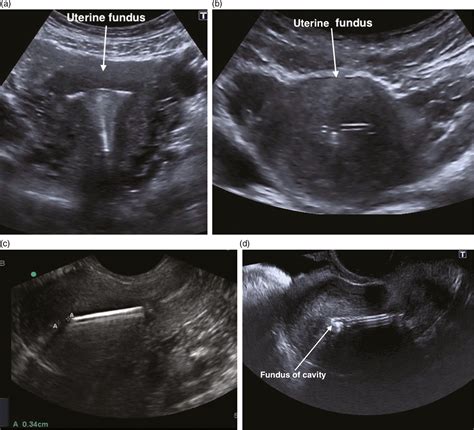 Intrauterine Ultrasound