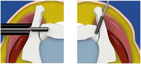 Sacroiliac Joint Surgery Uk